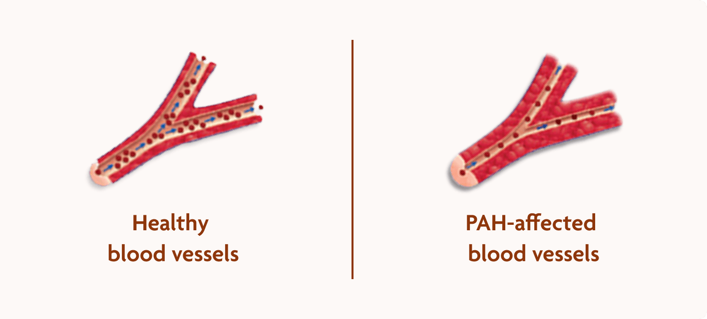 Healthy blood vessels vs blood vessels affected by PAH